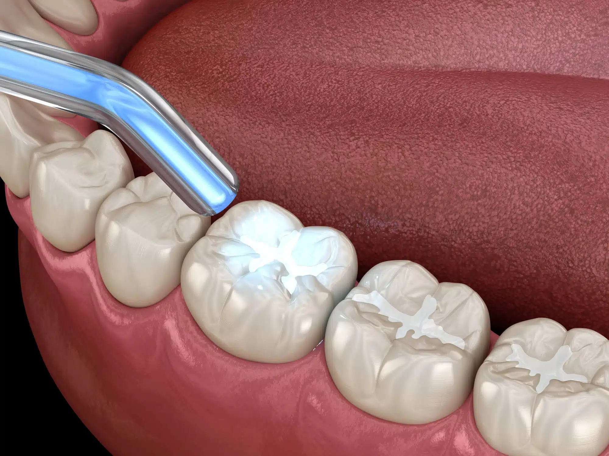 Tooth Restoration Procedure for Dental Crowns Riverview MI