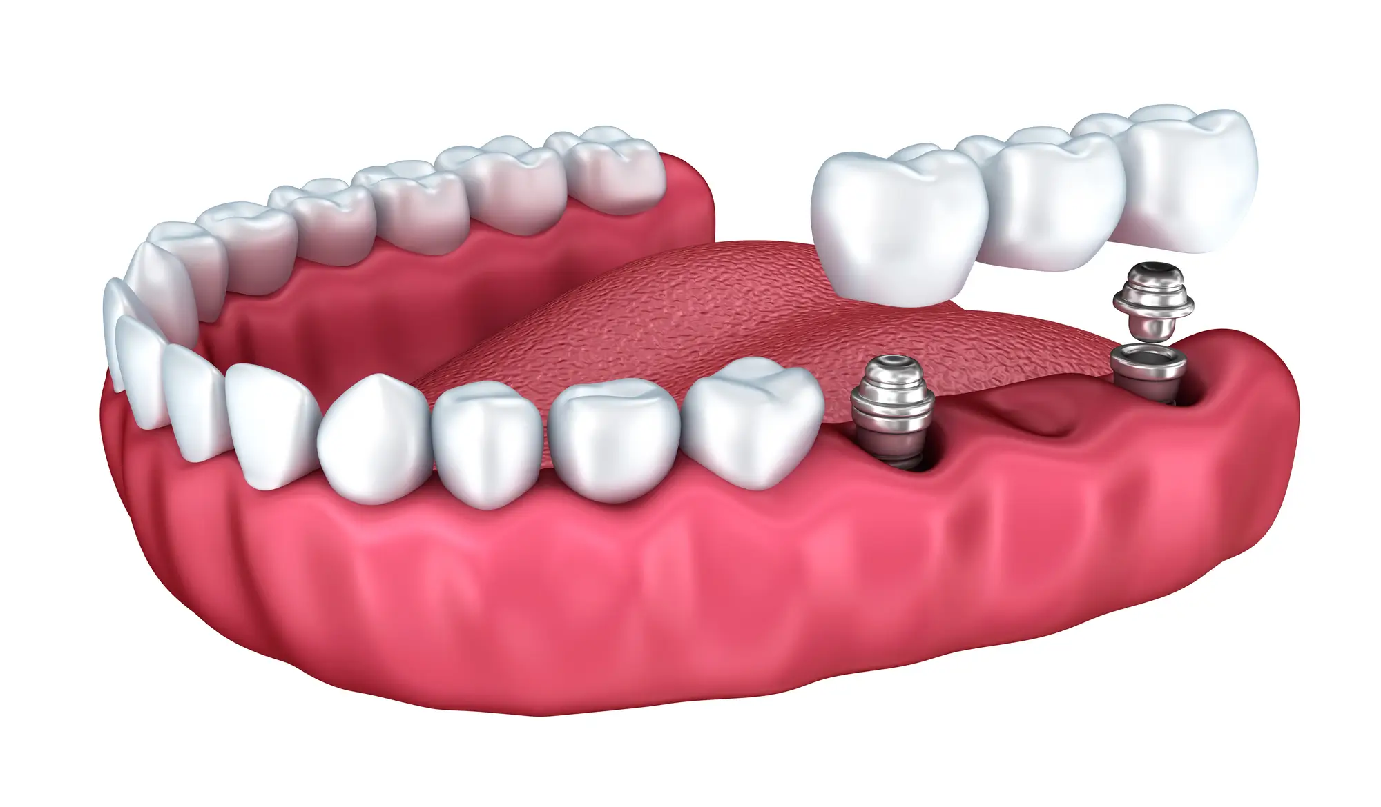 Dental Implants and Dental Bridges in Riverview, MI
