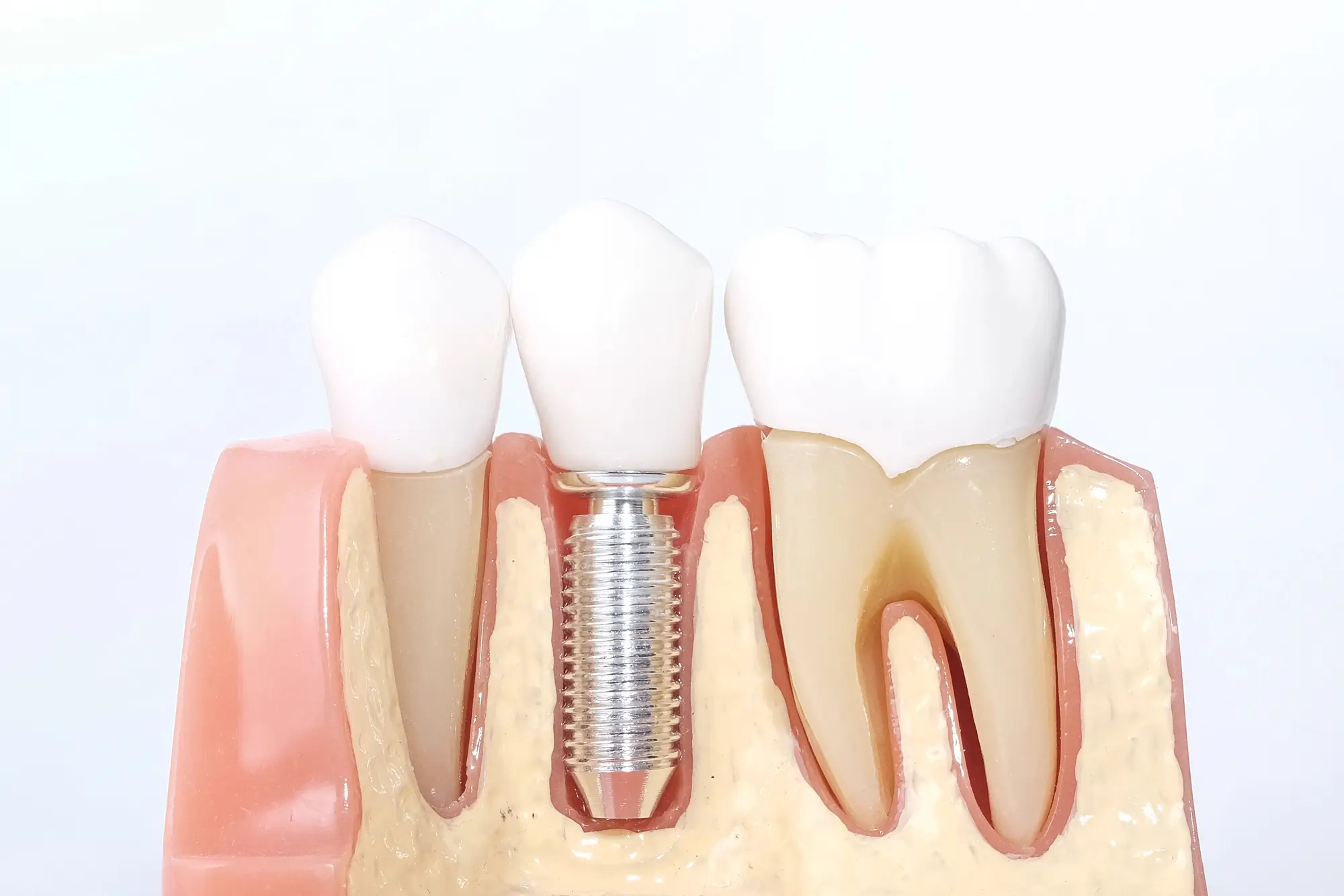 Dental Model for Dental Bridges in Riverview, MI
